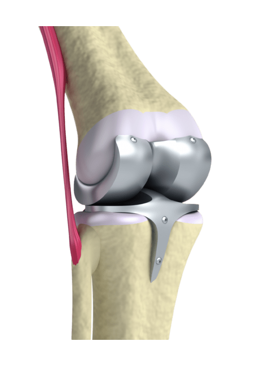 Affordable knee replacement surgery in Kadapa district